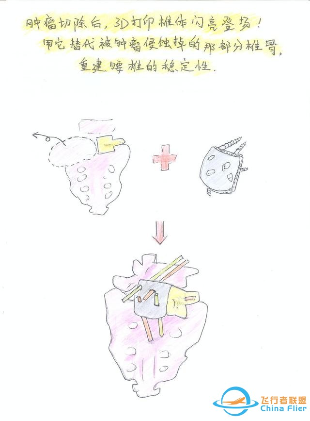 醫(yī)學(xué)領(lǐng)域的“AR 3D”技術(shù)究竟有多炫？10幅手繪漫畫給你講透-6165